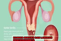 KANKER SERVIKS, kanker leher rahim