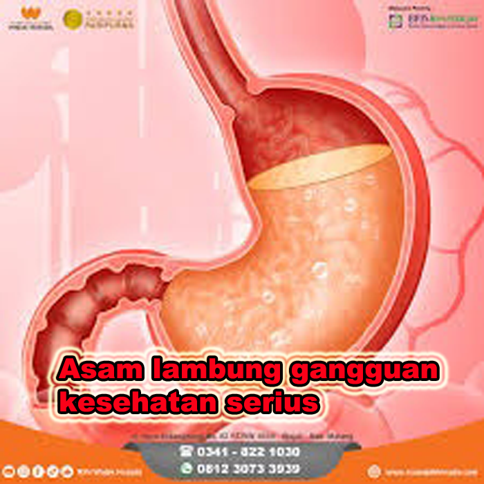 asam lambung gangguan kesehatan serius